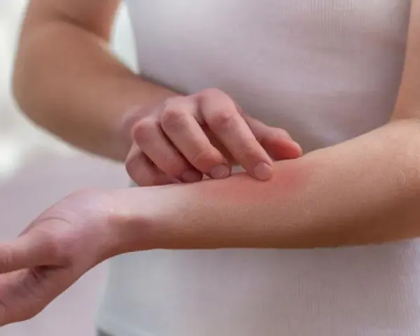 Dłoń drapiąca zaczerwienioną skórę na przedramieniu, objaw mogący wskazywać na lupus.