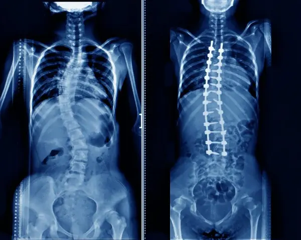 Rentgen klatki piersiowej pokazuje skoliozę kręgosłupa przed i po operacji korekcyjnej z implantami.