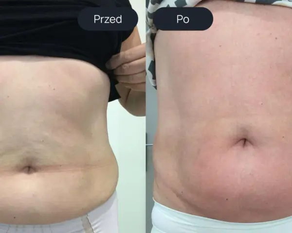 Porównanie brzucha przed i po endermologii. Widoczne wygładzenie skóry i redukcja tkanki tłuszczowej – spektakularne endermologia brzuch efekty.