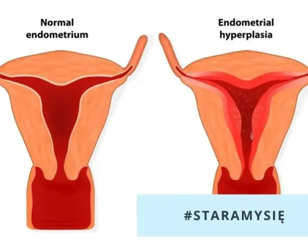 Porównanie prawidłowego endometrium z jego przerostem. Po lewej zdrowa macica, po prawej przerost endometrium.