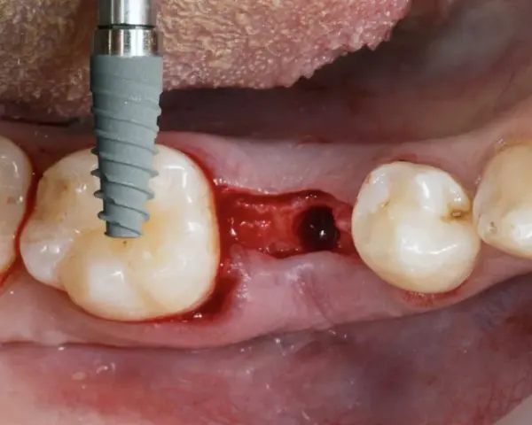 Kiedy implant po wyrwaniu zęba? Poznaj kluczowe terminy i ryzyka