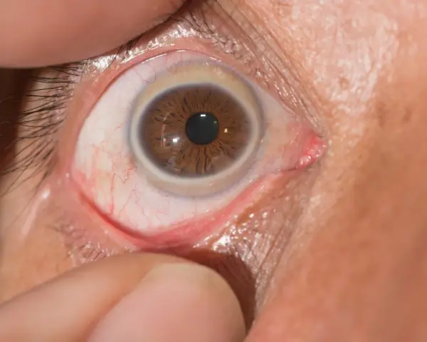 Occhio con iride marrone e un sottile anello di Weiss visibile intorno alla pupilla.