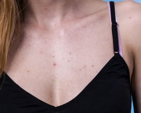 Pickel am Dekolleté können auf hormonelle Schwankungen hinweisen. Die Haut zeigt Rötungen und kleine Unreinheiten.