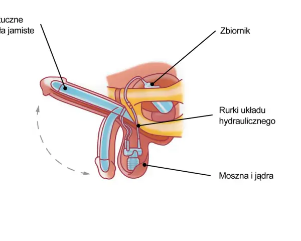 Schemat protezy penisa, która umożliwia erekcję dzięki hydraulicznemu układowi.