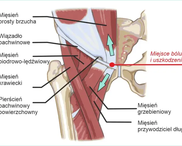 Anatomia pachwiny z zaznaczonym miejscem bólu i uszkodzenia, gdzie mięsień przywodziciel długi może być narażony.