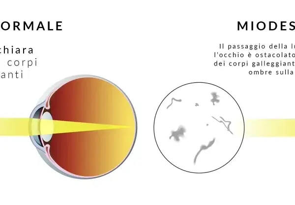 Confronto occhio normale e miodesopsia: corpi galleggianti nel vitreo ostacolano la luce. Ricerca cure naturali per il distacco del vitreo.