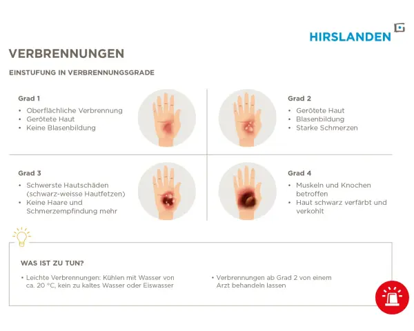 Verbrühungen: Grad 2 zeigt gerötete Haut, Blasenbildung und starke Schmerzen. Ein Arzt sollte ab Grad 2 konsultiert werden.