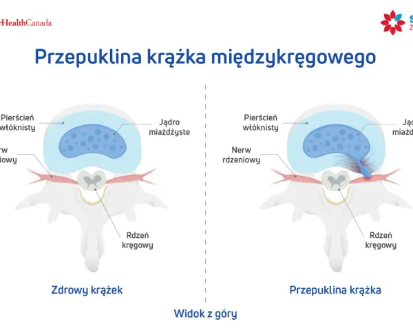 Porównanie zdrowego krążka międzykręgowego z przepukliną krążka szyjnego z uciskiem na worek oponowy.
