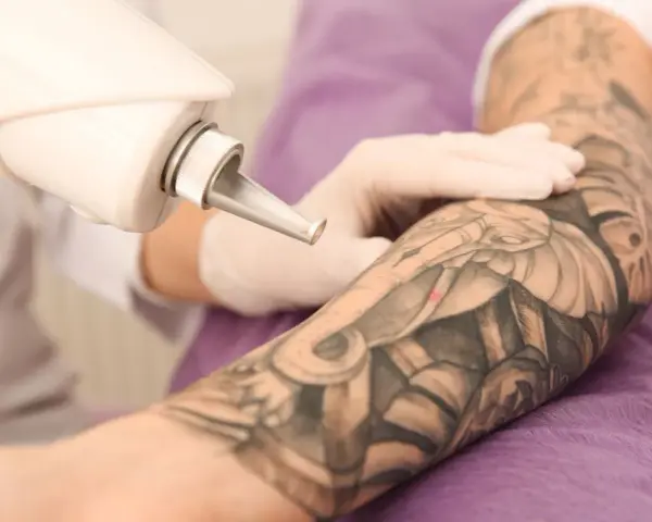 Ręka w rękawiczce trzyma laser do usuwania tatuażu z ręki.