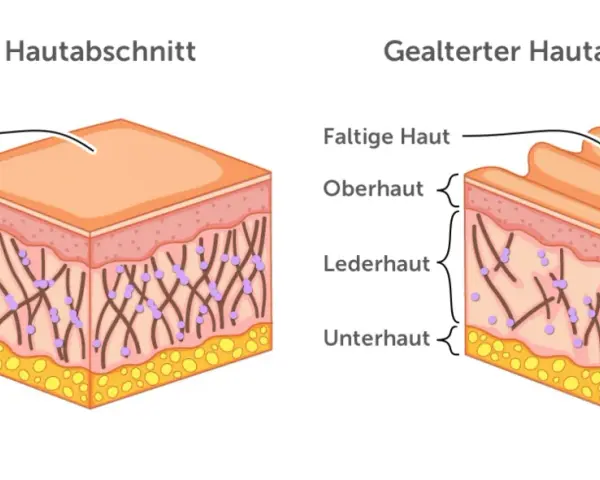 Vergleich von junger, glatter Haut und gealterter, faltiger Haut. Die Lederhaut zeigt bei trockene Haut im Alter weniger Kollagenfasern.
