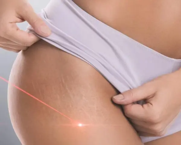 Skóra z widocznymi rozstępami, na którą skierowane są czerwone linie lasera. Zabieg laserowe usuwanie rozstępów.
