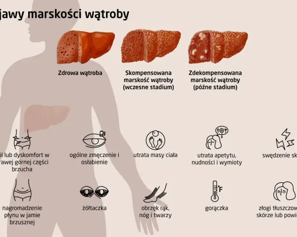 Ilustracja pokazuje zdrowe i chore wątroby, a także objawy marskości wątroby: ból brzucha, zmęczenie, utratę masy ciała, żółtaczkę, obrzęki, gorączkę i zmiany skórne.