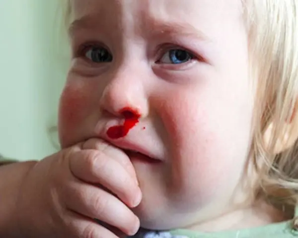 Małe dziecko z krwawiącym nosem. Krwawienie z nosa z jednej dziurki może mieć różne przyczyny, np. uraz lub suchość.