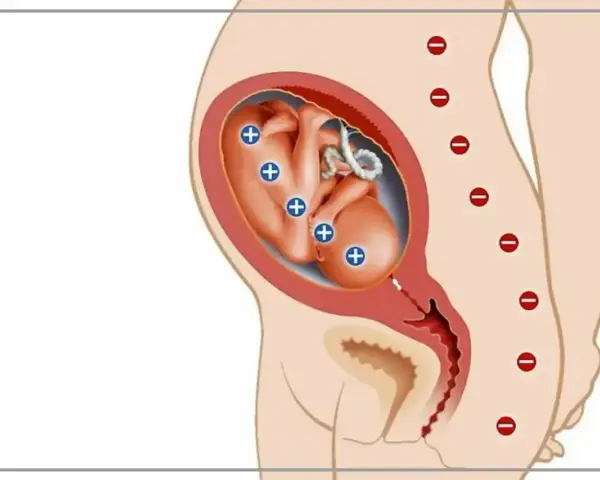Ilustracja pokazuje płód w macicy z oznaczeniami "+" na ciele, co symbolizuje konflikt serologiczny. Matka ma oznaczenia "-" na kręgosłupie.