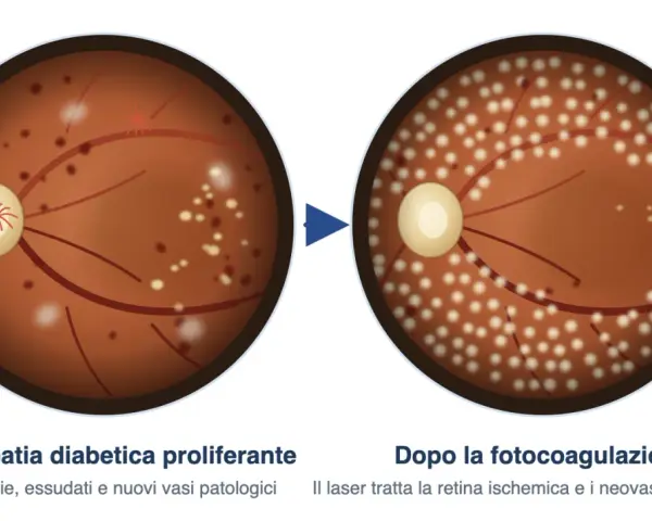 Retinopatia diabetica proliferante con emorragie e essudati, prima e dopo il trattamento laser che riduce la lesione retinica.