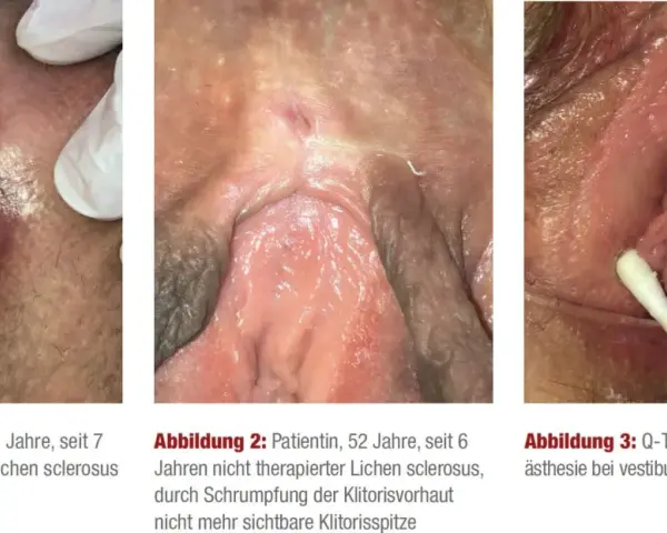 Drei Bilder zeigen die Auswirkungen von Lichen sclerosus: eine entzündete Vulva, eine geschrumpfte Klitoris und einen Q-Tip-Test.