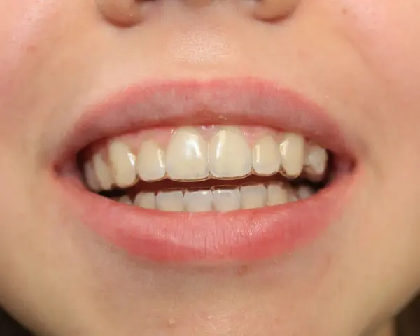 Zbliżenie na uśmiech z widocznymi przezroczystymi nakładkami Invisalign na zębach.