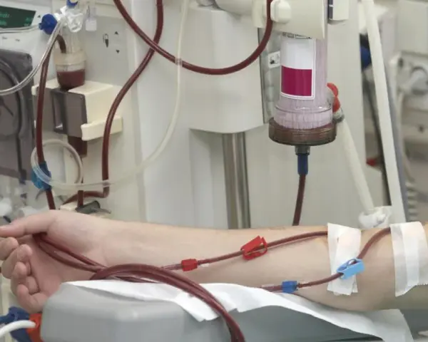 Ramię pacjenta podłączone do aparatury dializacyjnej z widocznymi przewodami i filtrem.