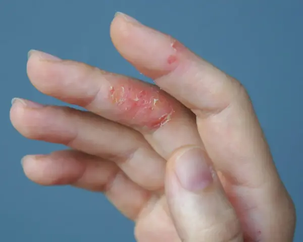 Dedos con piel irritada y escamosa, indicando un fuerte picor en las manos.