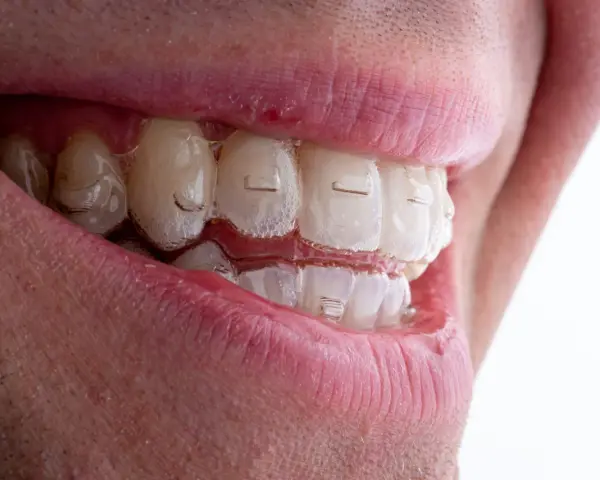 Uśmiech z przezroczystymi nakładkami Invisalign. Zastanawiasz się nad Invisalign cena? To inwestycja w prosty zgryz.