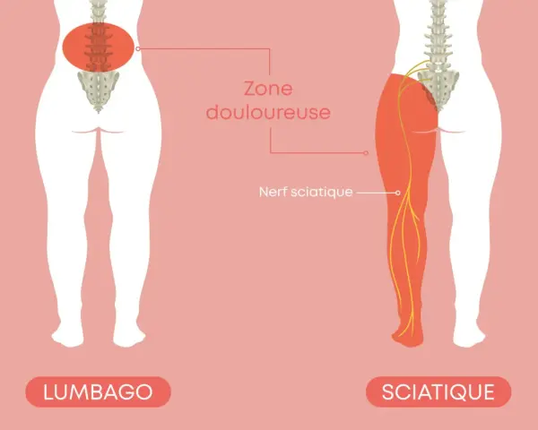 Illustration comparant le lumbago et la sciatique. La sciatique, combien de temps dure-t-elle ? Le nerf sciatique est montré irradiant dans la jambe.