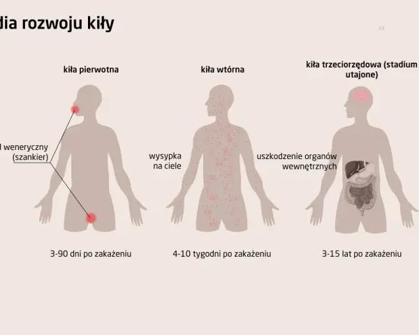 Ilustracja przedstawia stadia rozwoju kiły: pierwotna (wrzód), wtórna (wysypka skórna) i trzeciorzędowa (uszkodzenia narządów).