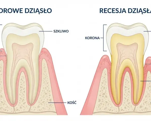 Zdrowe dziąsło vs recesja dziąsła. Recesja powoduje odsłonięcie korzenia i może prowadzić do bólu dziąsła między zębami.