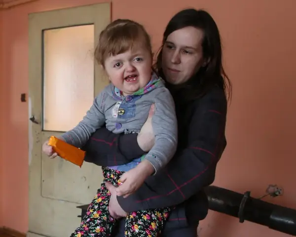 Matka trzyma dziecko z zespołem Aperta. Długość życia zależy od wielu czynników, ale miłość i wsparcie są kluczowe.