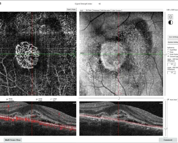 Immagine OCT di un occhio destro, mostra un ispessimento retinico con neovascolarizzazione coroideale, possibile causa di problemi visivi.