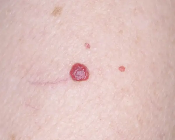 Piel con varios lunares rojos de diferentes tamaños, algunos pequeños y otros más prominentes, junto a finas venas.