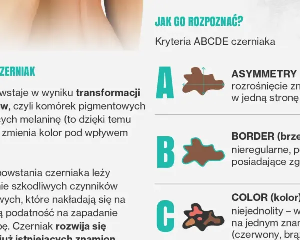 Jak rozpoznać czerniaka? Poznaj kryteria ABCDE: asymetria, brzegi, kolor, średnica i ewolucja znamienia. Dbaj o swoją skórę!