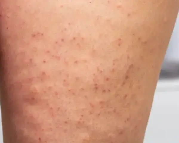 Eingewachsenes Haar am Bein: Ursachen, Behandlung und Vorbeugung