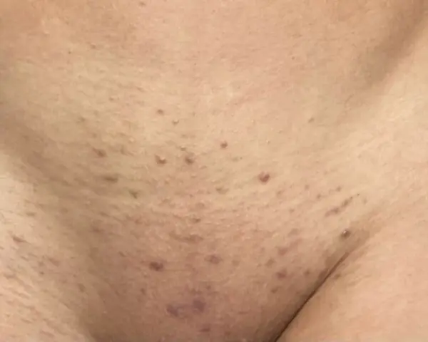 Red bumps and irritation on the skin, indicative of folliculitis and a histamine reaction after waxing.