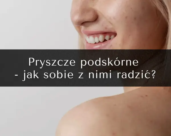 Uśmiechnięta twarz z piegami i pryszczami. Na ramionach widoczne są kolejne zmiany skórne. Tekst: "Pryszcze podskórne - jak sobie z nimi radzić?".