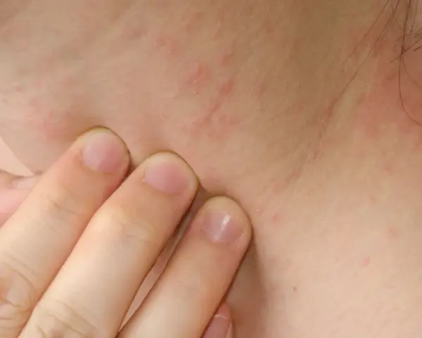 Delikatne plamy wątrobowe na szyi, widoczne pod palcami, sugerują potrzebę konsultacji dermatologicznej.