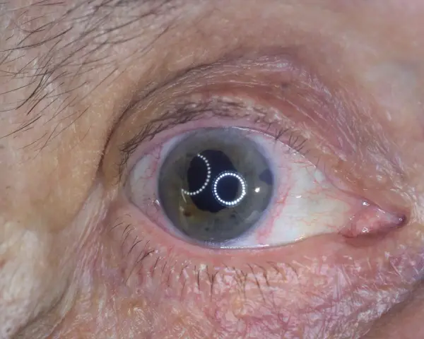 Occhio con iride verde-grigia e riflessi luminosi. Si nota una piccola apertura nell'iride, tipica di un intervento di iridectomia cos'è.