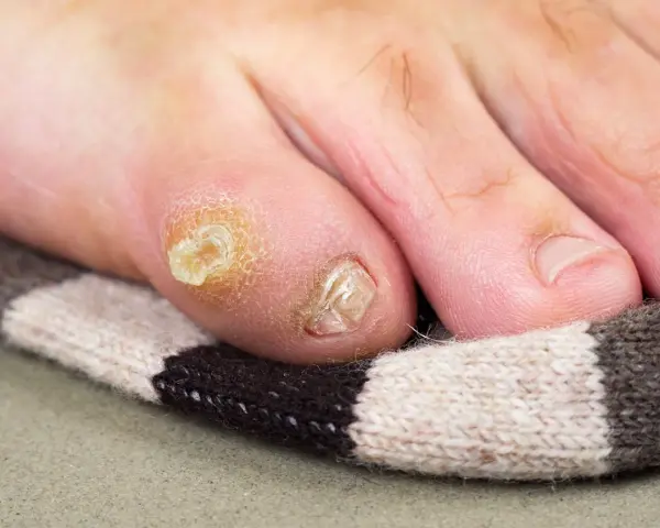 Un oignon au pied, un remède de grand-mère à base d'oignon pourrait aider. Gros plan sur un orteil avec un cor et un ongle abîmé.