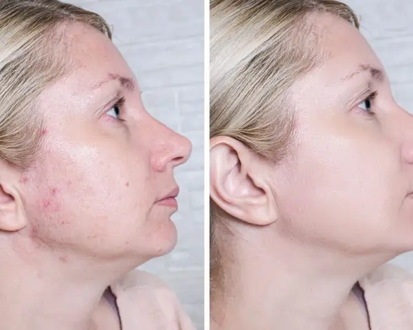 Przed i po: skóra z niedoskonałościami i zaczerwienieniami (acne) po zastosowaniu produktu, który wyrównał koloryt i wygładził cerę.