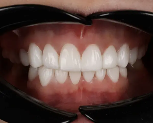 Piękne, białe zęby po zabiegu dental bonding. Uśmiech jak z reklamy!
