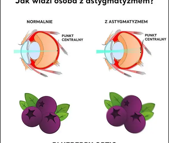 Astygmatyzm: plusy i minusy na recepcie? Zrozum swoją wadę!