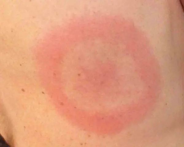 Rodnad ring på huden, som om det vore knottrig hud som kliar. Ser ut som ett bett.