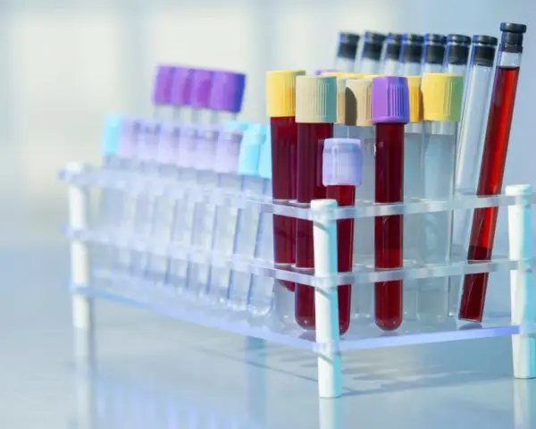 Rurki z krwią w stojaku laboratoryjnym. Czy to badanie CA 125?