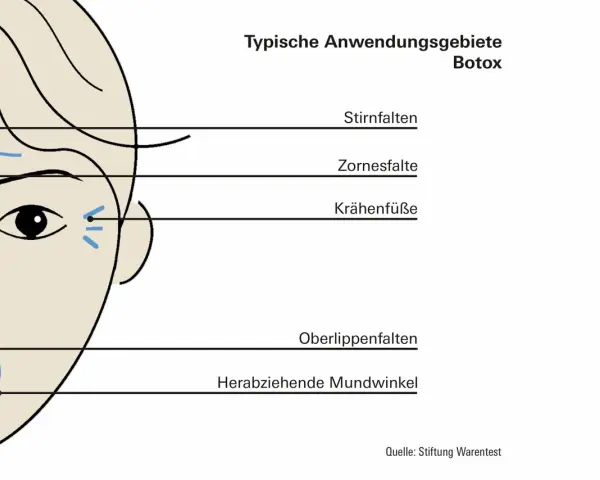 Schema zeigt typische Anwendungsgebiete für Botox, z.B. Stirnfalten, Zornesfalten, Krähenfüße.
