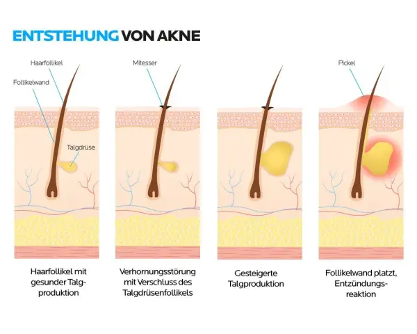 Pickel bei empfindlicher Haut? Meine Expertentipps für reine Haut