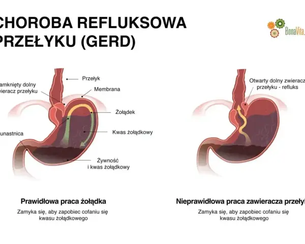 Ilustracja pokazuje prawidłowe i nieprawidłowe działanie żołądka, wyjaśniając objawy refluksu.