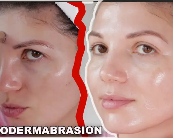 Woman using a microdermabrasion device on her forehead. Learn how to clean microdermabrasion tips for best results.