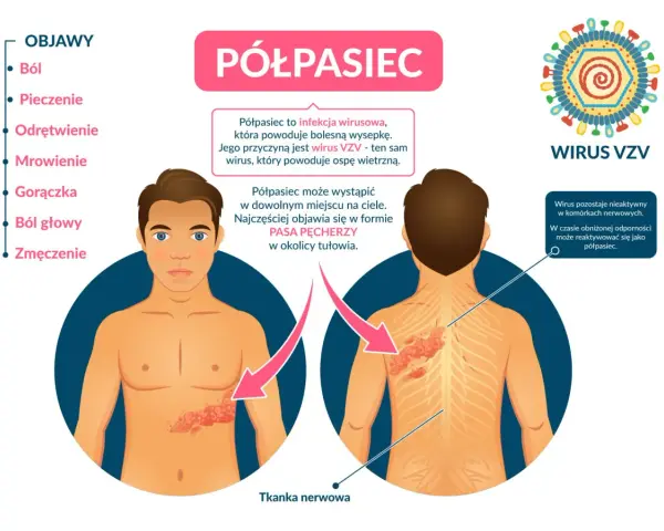 Ilustracja przedstawia objawy półpaśca na ciele człowieka: wysypkę na tułowiu i plecach, wirusa VZV oraz listę objawów.