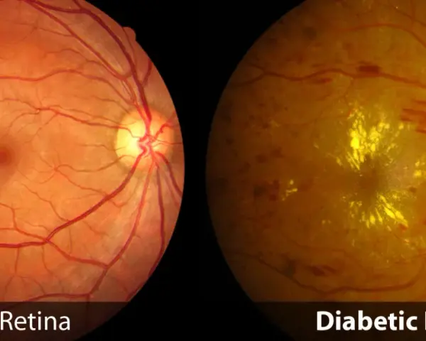 Confronto tra retina sana e retina diabetica: la seconda mostra emorragie e depositi gialli, sintomi della retinopatia diabetica.