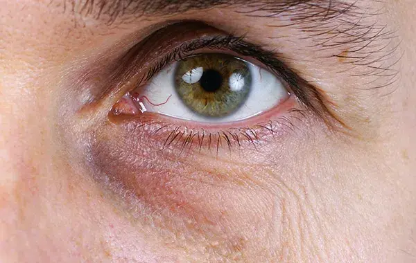 Eisenmangel symptome augen: Dunkle Augenringe und ihre Ursachen erkennen