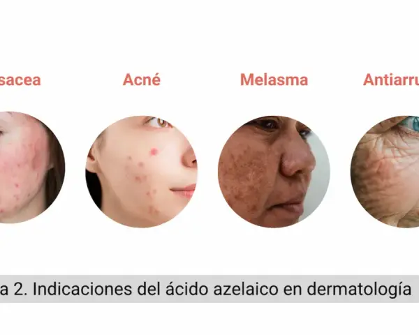 El ácido azelaico sirve para tratar rosácea, acné, melasma y arrugas, mostrando su versatilidad en dermatología.